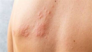 هيئة الدواء المصرية تقدم معلومات عن علاج فيروس الهربس 