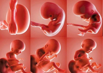 أطباء جامعة المنوفية يستخرجون تكوينًا جنينيًا من معدة طفلة