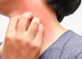الحكة الجلدية في فصل الخريف.. أسبابها ومتى تحتاج إلى علاج؟