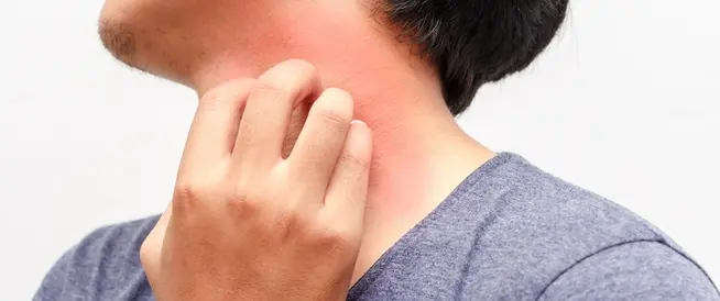 الحكة الجلدية في فصل الخريف.. أسبابها ومتى تحتاج إلى علاج؟